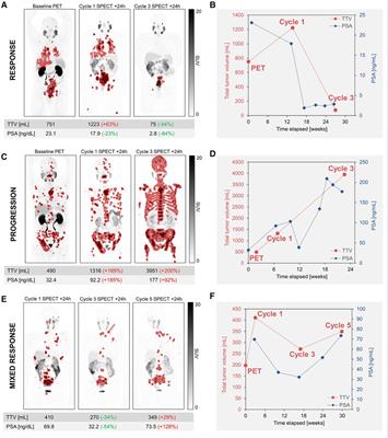 Quantitative imaging for 177Lu-PSMA treatment response monitoring and dosimetry